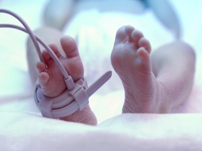 Feet of a premature new born baby under ultraviolet lamp