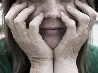 A young woman with burn scars on her hands