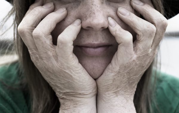 A young woman with burn scars on her hands